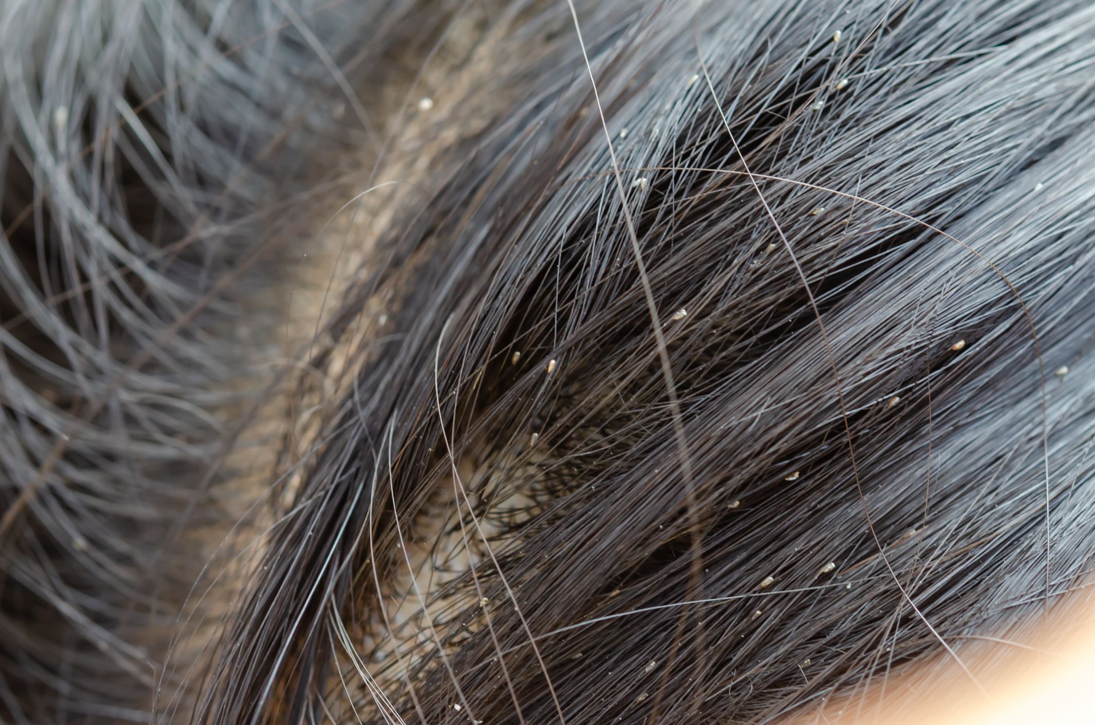 Dream About Lice or Nits – Spiritual And Biblical Meaning