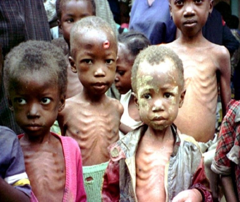 Malnutrition: Causes, Symptoms, Types And Characteristics